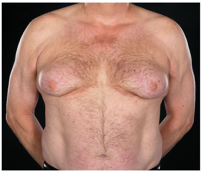 Gynecomastia Induced by Prostate-Cancer Treatment