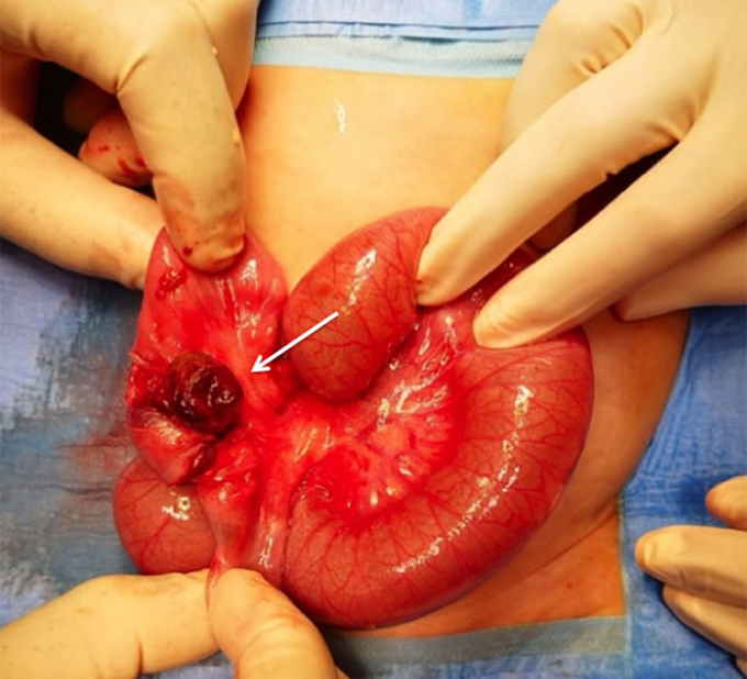 Neonatal Intussusception Secondary to Meckel’s Diverticulum in a Neurologically Impaired Child