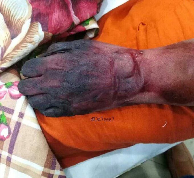 A casestudy of dry gangrene