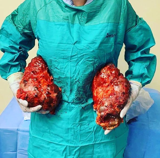 Polycystic kidney disease (PKD): 