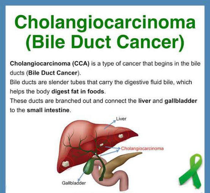 Visual representation of Bile duct cancer