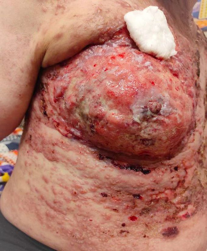 Breast cancer of a 67 year old woman