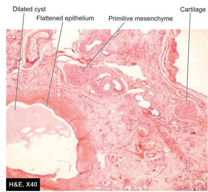 Renal cystic dysplasia.