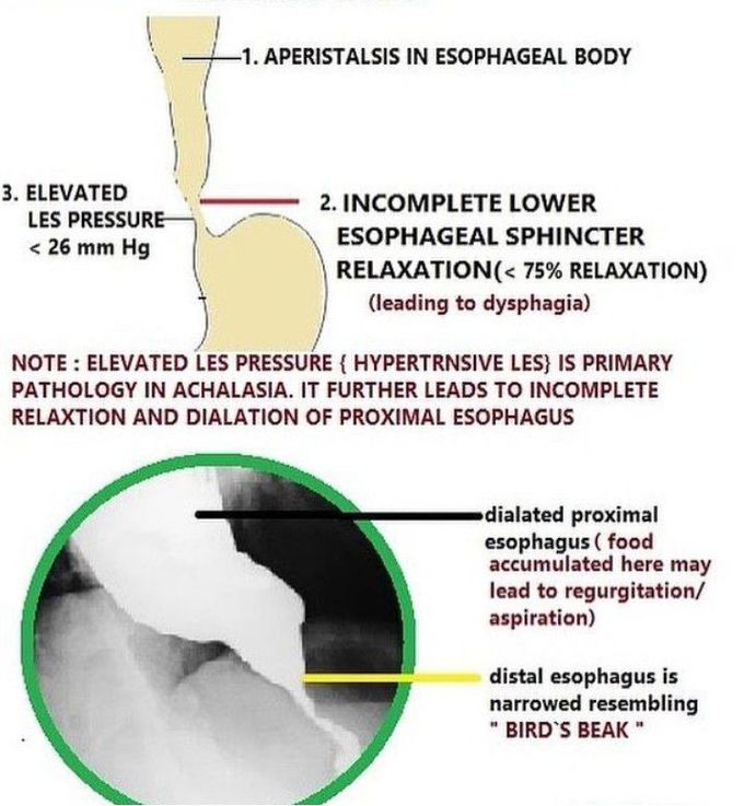 Achalasia Cardia