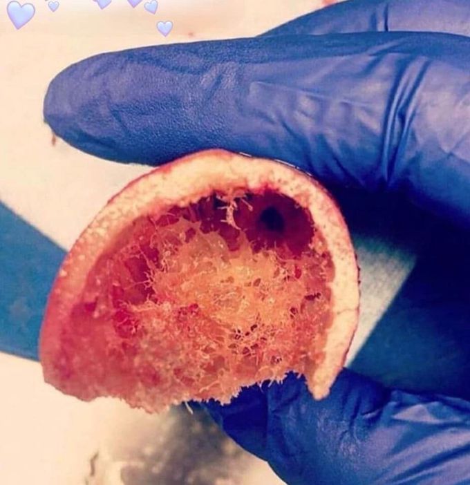 Bone marrow