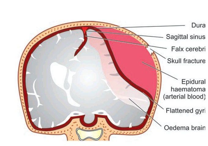 Epidural haematoma