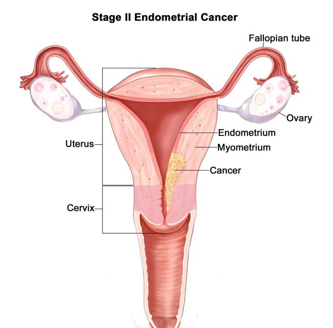 Endometrial cancer