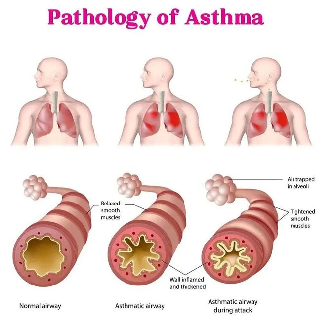 Pathology of Asthma