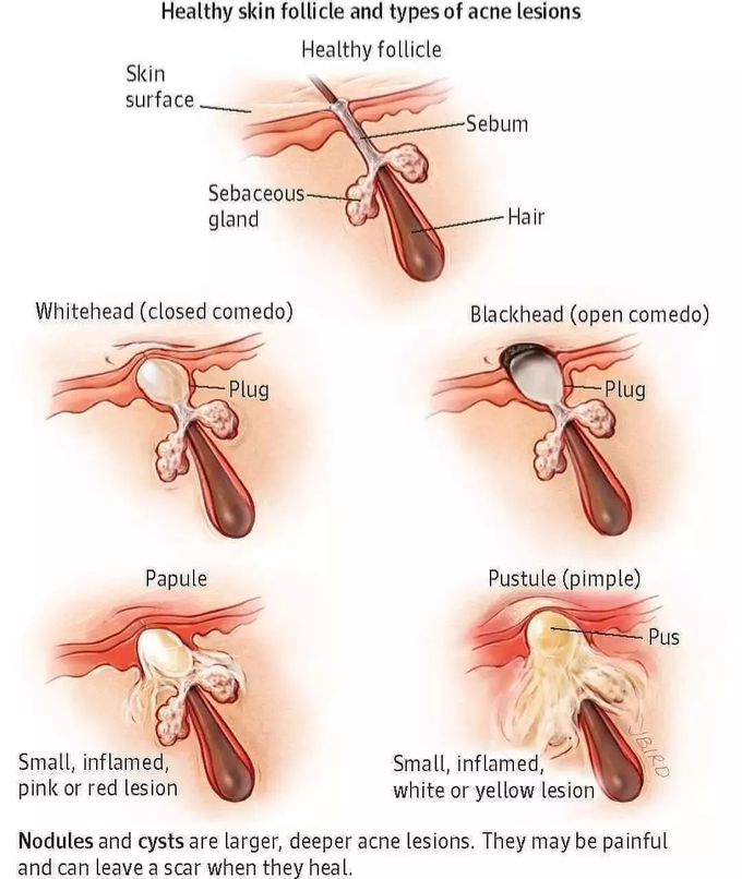 Healthy Vs unhealthy hair follicles