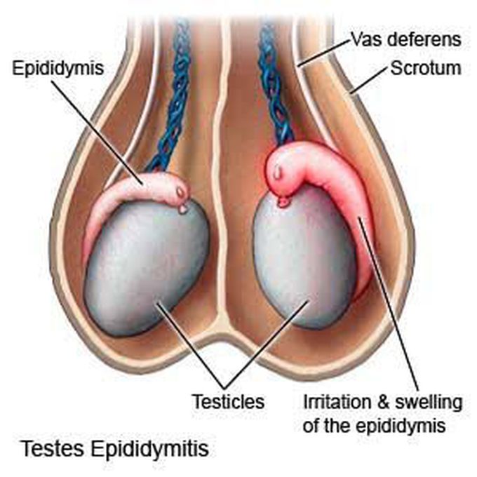 Chronic epididymitis