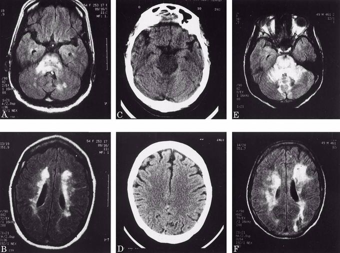 Hypertensive Encephalopathy