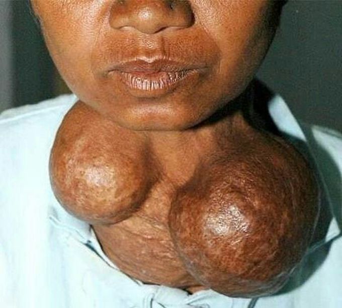 A goiter, is a swelling in the neck resulting from an enlarged thyroid gland. A goiter can be associated with a thyroid that is not functioning properly.