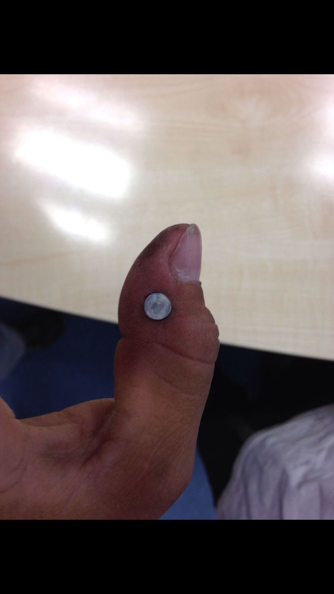 Young worker nailed his finger