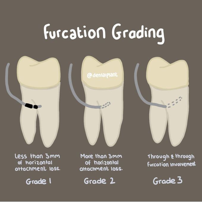 Furcation Grading