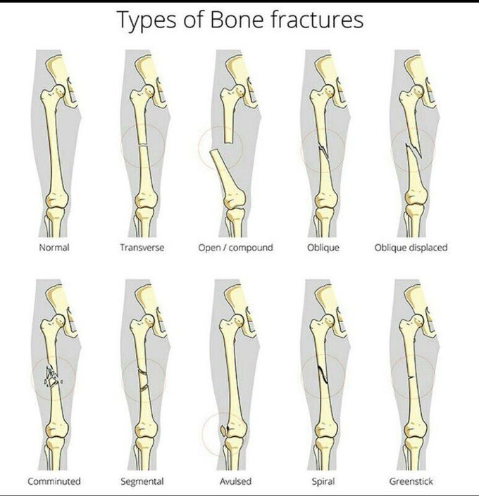 Different types of bone fracture
