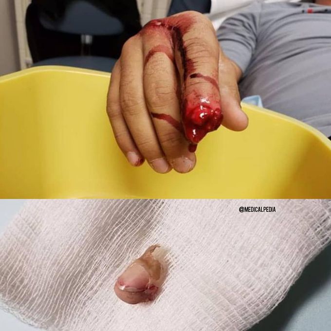 Can you imagine going to the gym to lose some weight and you end up losing a finger?
