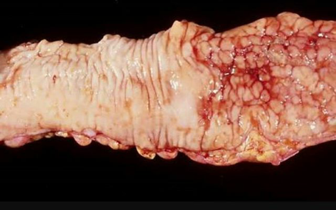 Cobblestone appearance of Crohn's with skip lesions 