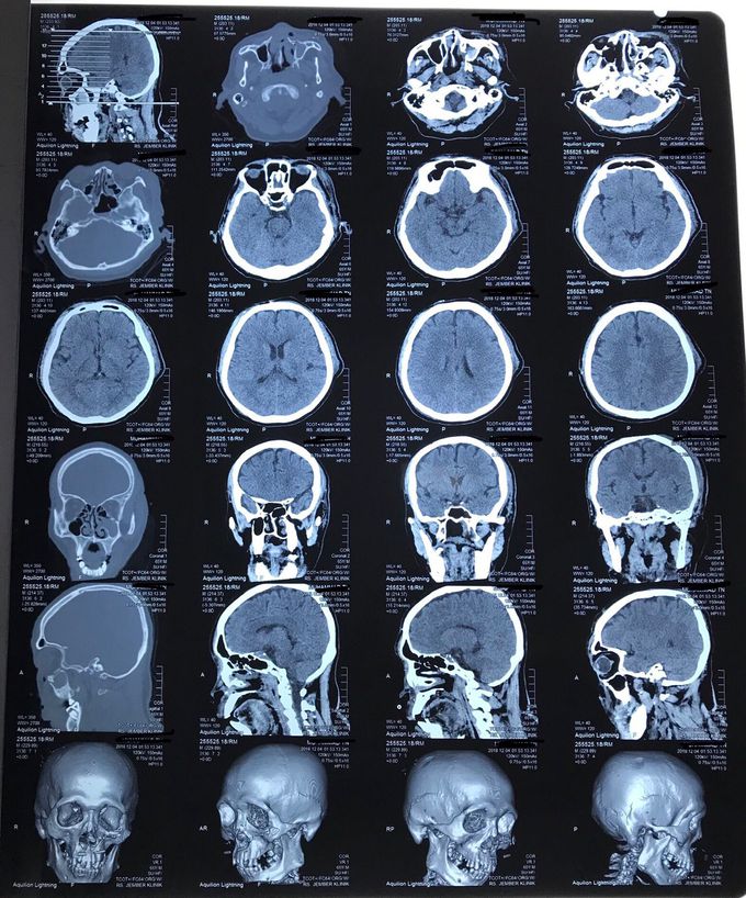 Head CT Scan