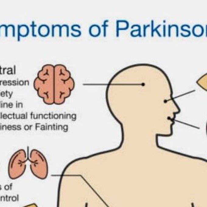 Parkinson