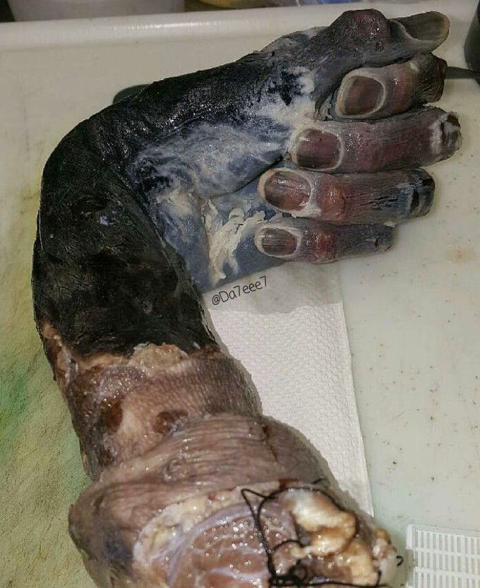 A dry Gangrene case
