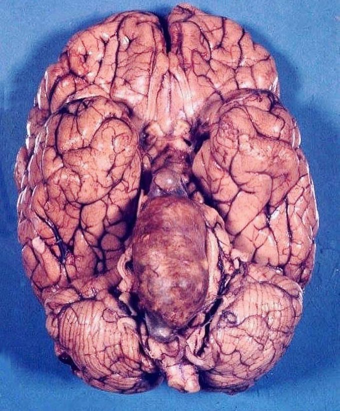 Basilar artery aneurysm