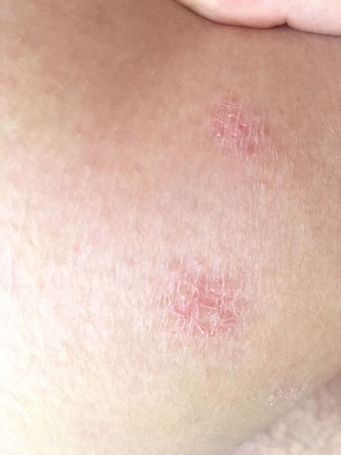 Rough round reddish rash 1cm in diameter