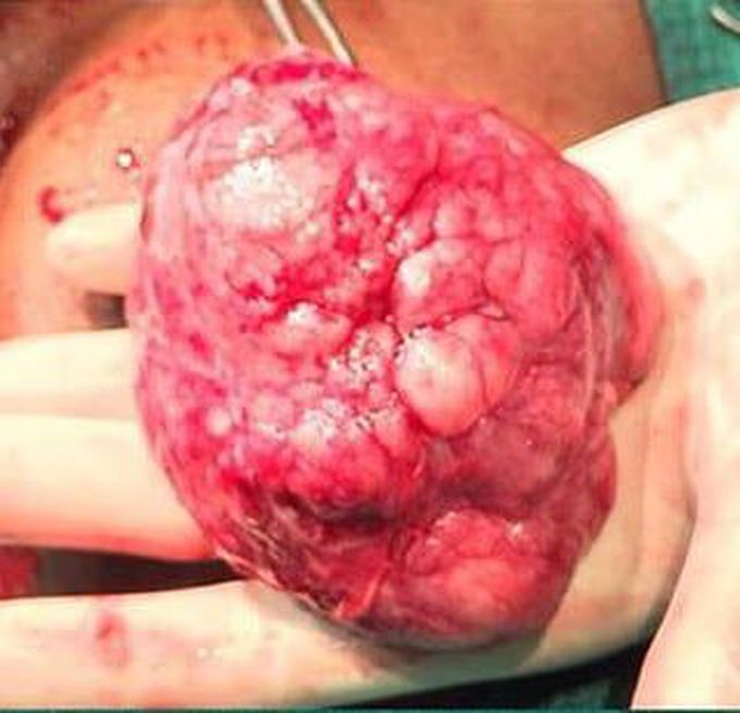 Gaint fibroadenoma breast cancer.