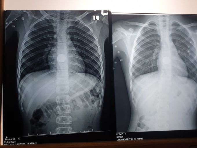 Foreign body esophagus