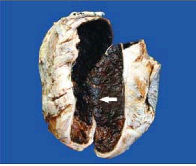 Haematocele testis.