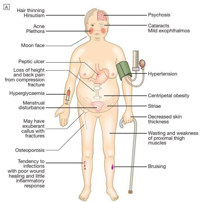 Cushing's syndrome