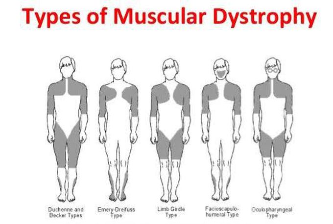 These are the types of muscular dystrophy