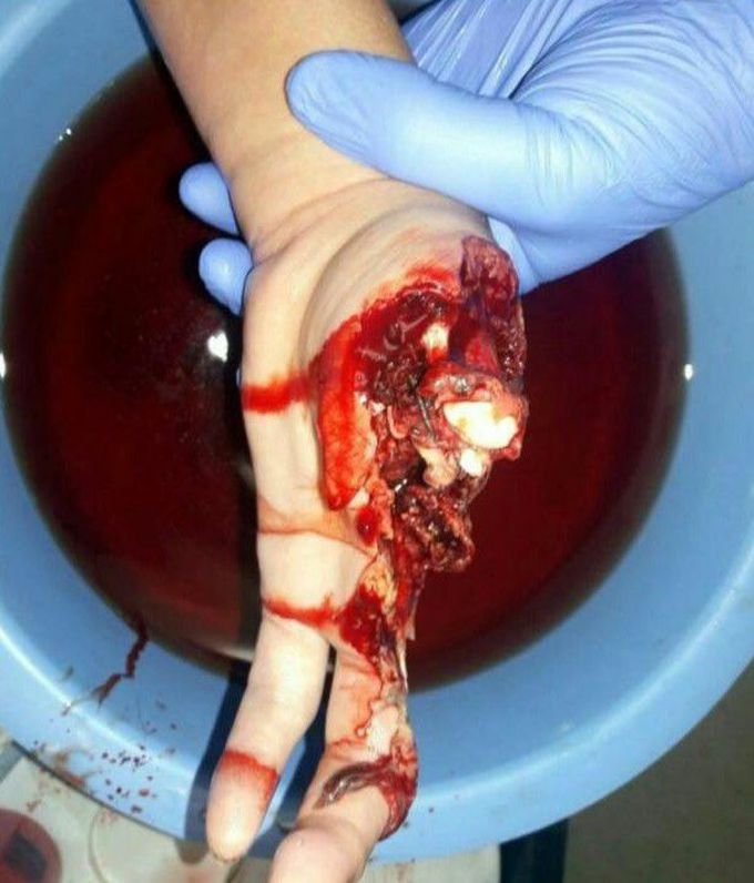 Hand bitten off