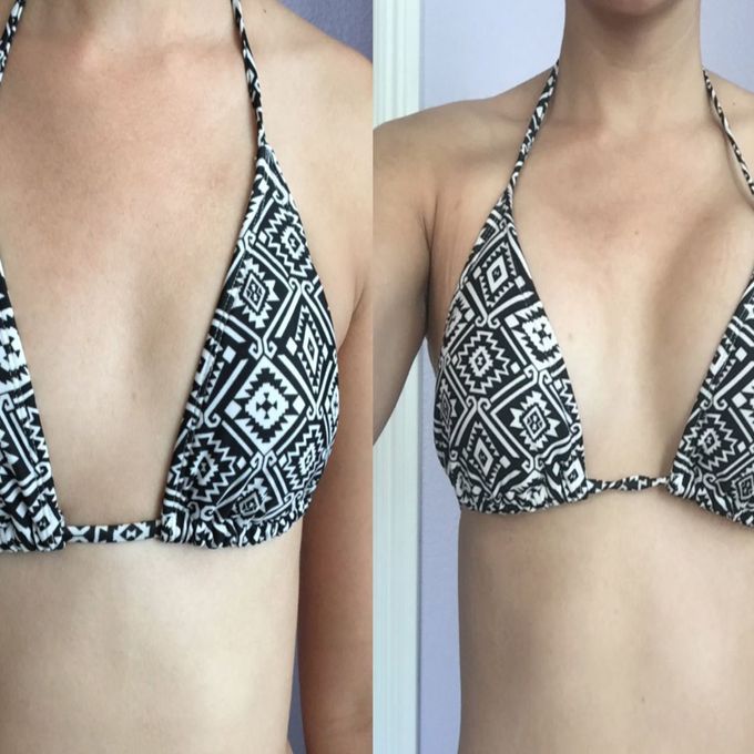 Breast Implant in Delhi