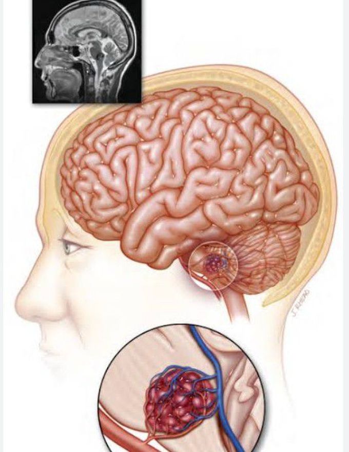 Cause of Brain lesions