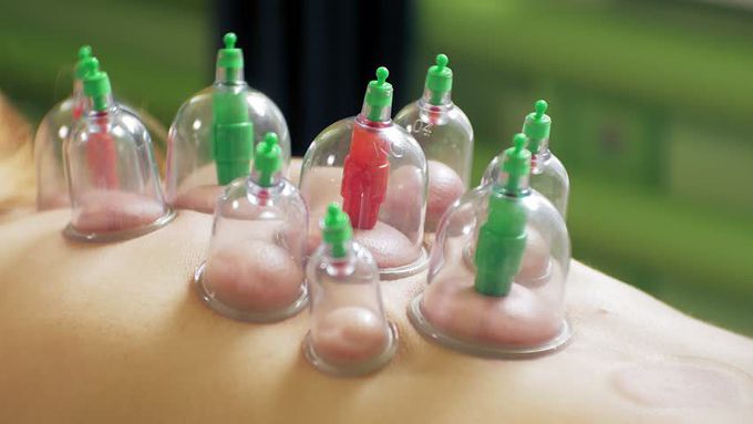 A Complicated Case of Sacral Neuromodulation