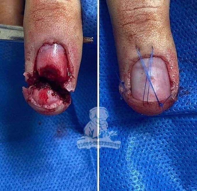Finger injury