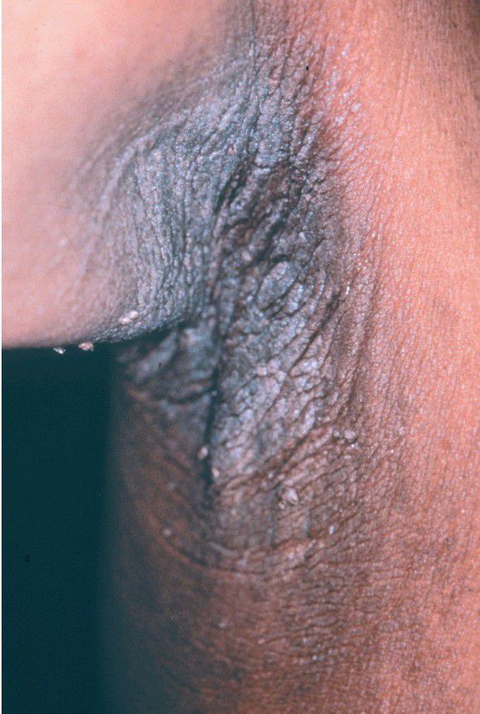 Acanthosis Nigricans.