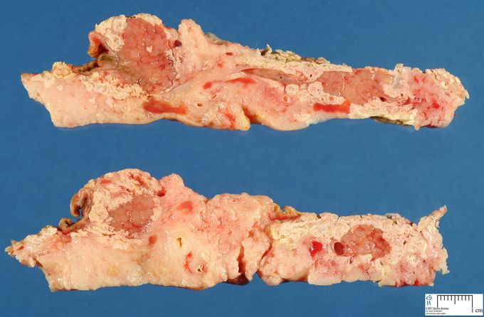 Acute Pancreatitis