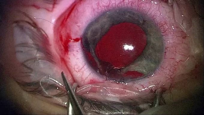 Complex Repair of Severe Blunt Eye Trauma
