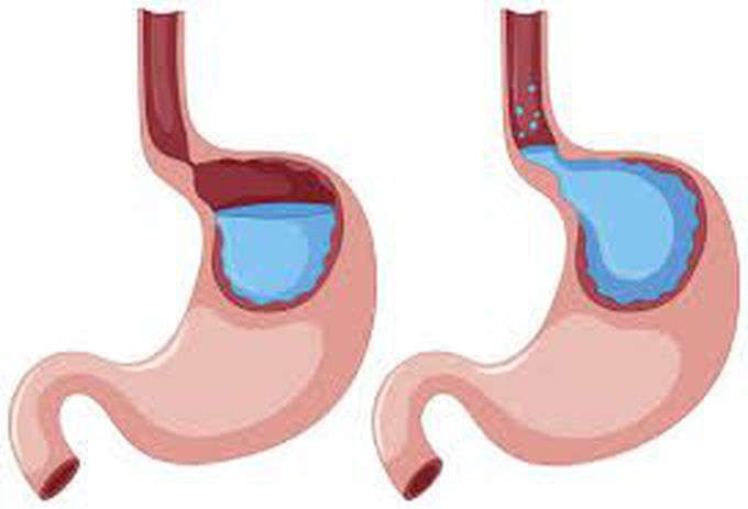 Treatment of gerd