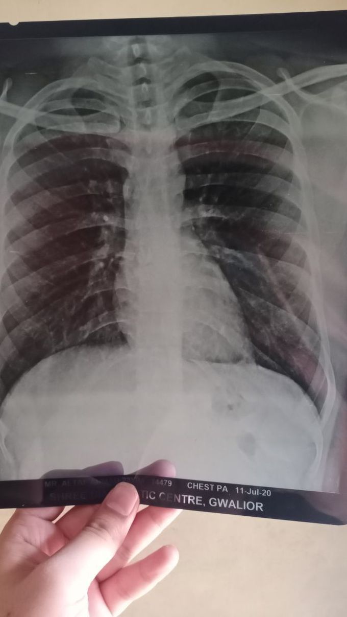 Chest x-ray.... Any diagnosis Or normal ??? Tell me pls