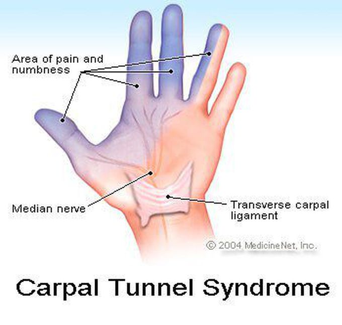 Carpal Tunnel Syndrome