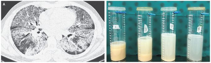 Crazy Paving in Pulmonary Alveolar Proteinosis