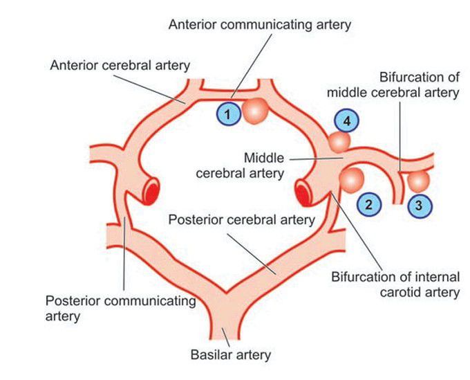 Berry aneurysm