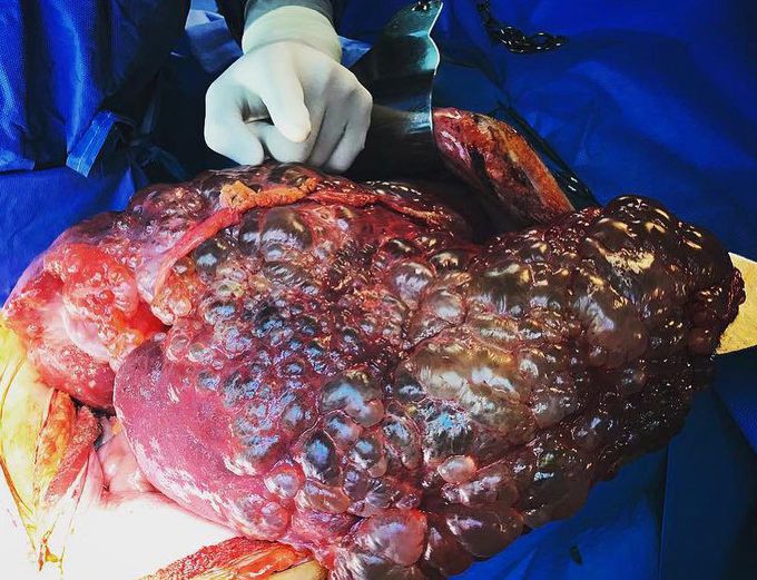 Giant polycystic liver!