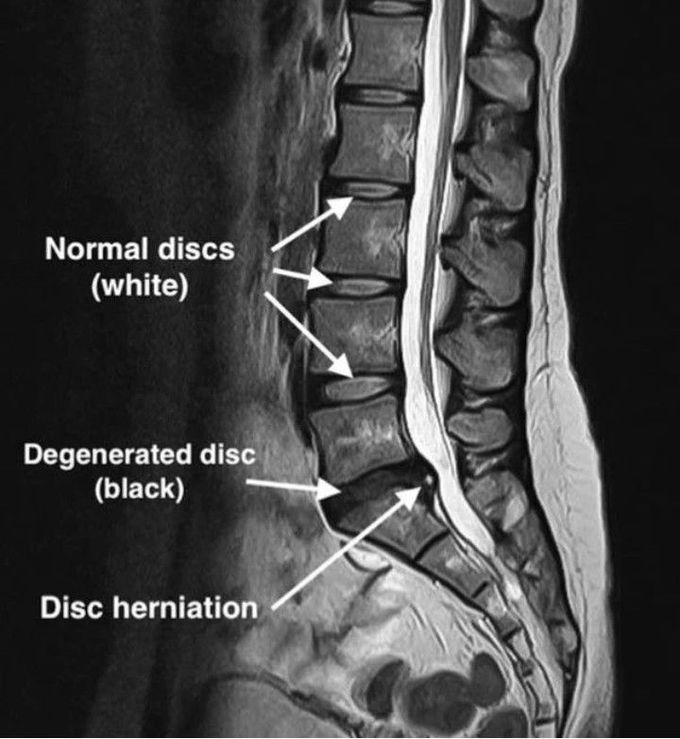 Normal  Vs Abnormal Disc