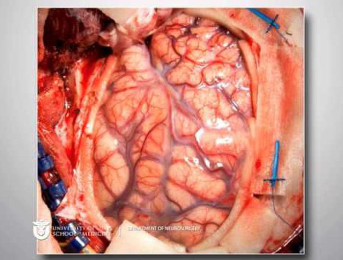 Nav-guided transsylvian approach & microsurgical resection of a deep left temporal low-grade AVM