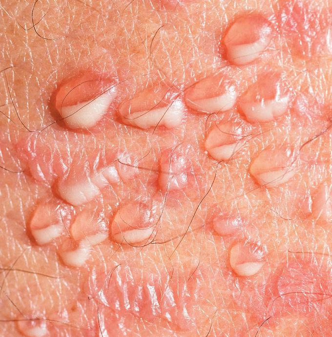“Half-Half” Blisters