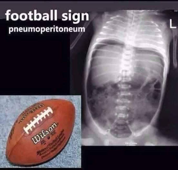 Pneumoperitoneum