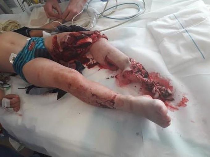 Lawnmower accident